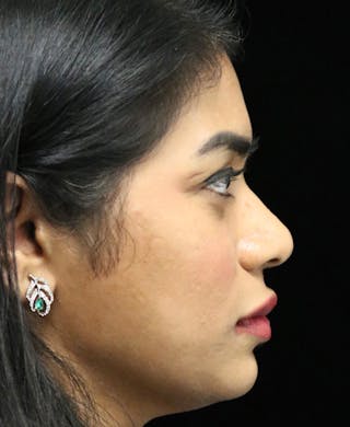 Beverly Hills Rhinoplasty Before & After Gallery - Patient 492793 - Image 2 Dr. Deepak Raj Dugar