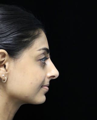 Beverly Hills Rhinoplasty Before & After Gallery - Patient 257114 - Image 2 Dr. Deepak Raj Dugar