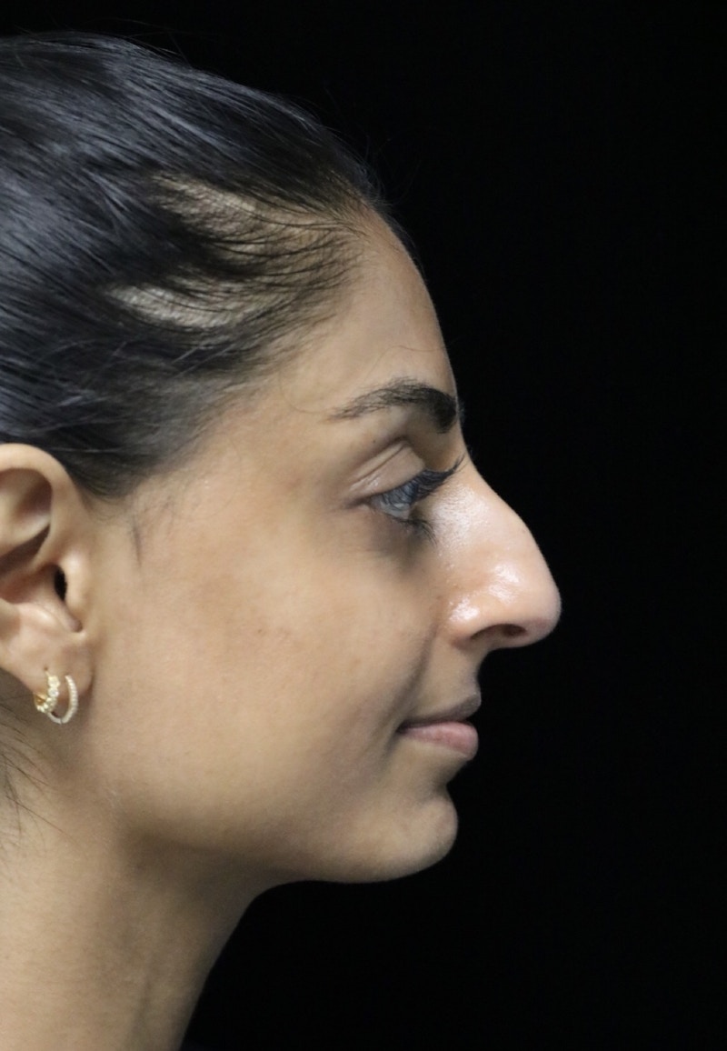 Beverly Hills Rhinoplasty Before & After Gallery - Patient 257114 - Image 1 Dr. Deepak Raj Dugar
