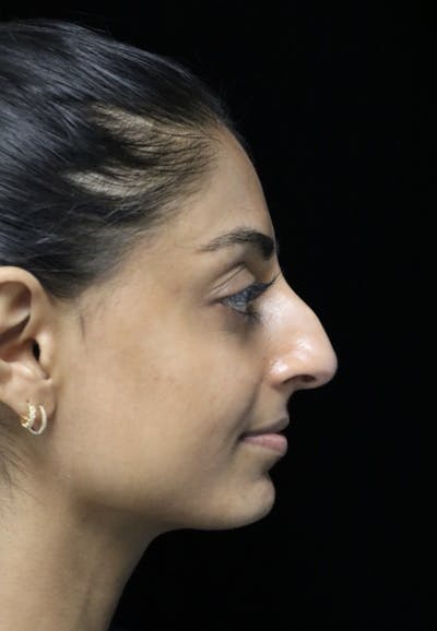 Beverly Hills Rhinoplasty Before & After Gallery - Patient 257114 - Image 1 Dr. Deepak Raj Dugar