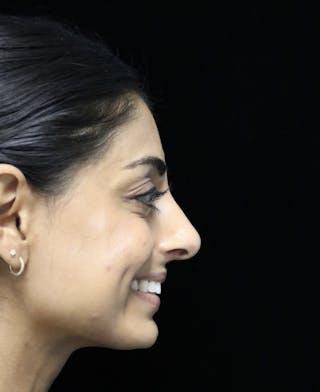 Beverly Hills Rhinoplasty Before & After Gallery - Patient 257114 - Image 6 Dr. Deepak Raj Dugar