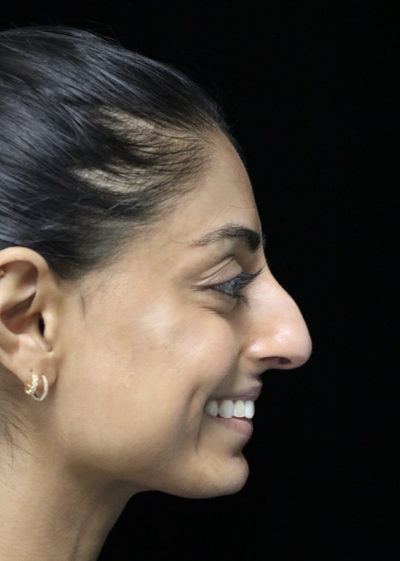 Beverly Hills Rhinoplasty Before & After Gallery - Patient 257114 - Image 5 Dr. Deepak Raj Dugar