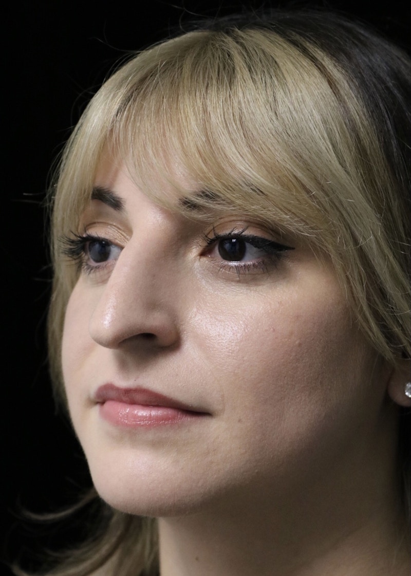 Beverly Hills Rhinoplasty Before & After Gallery - Patient 201183 - Image 11 Dr. Deepak Raj Dugar