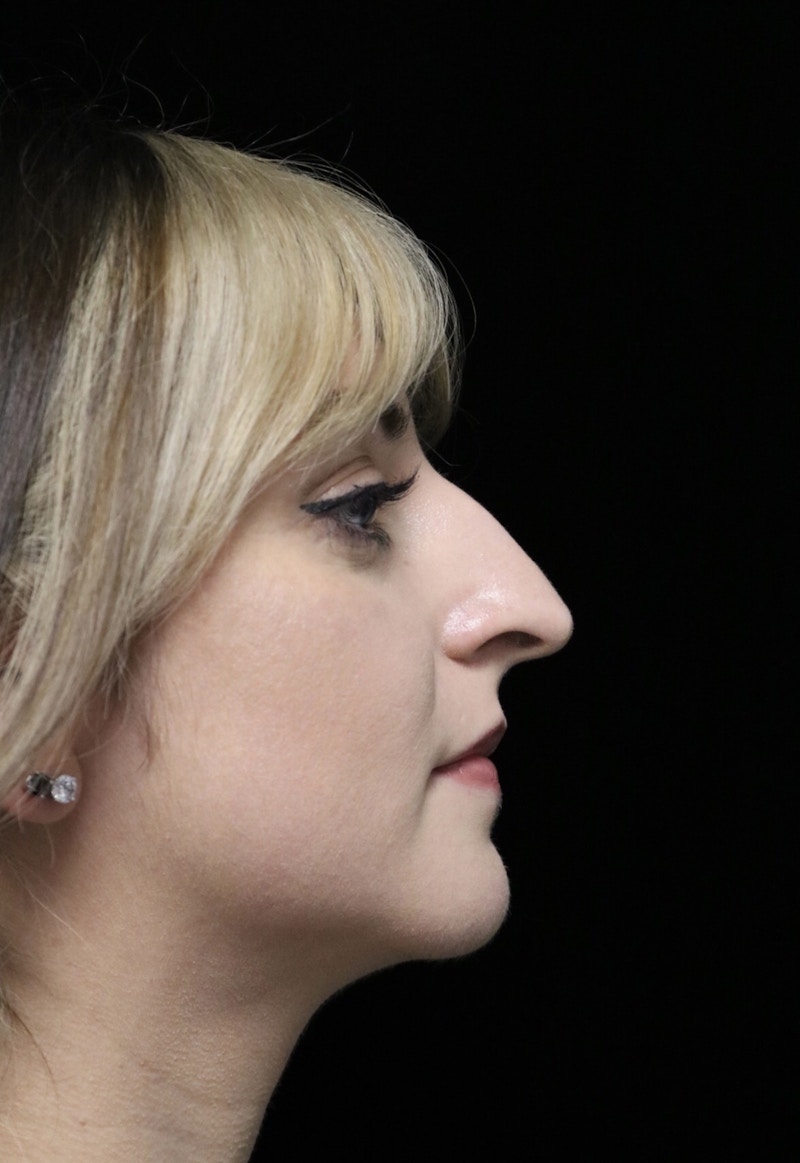 Beverly Hills Rhinoplasty Before & After Gallery - Patient 201183 - Image 1 Dr. Deepak Raj Dugar