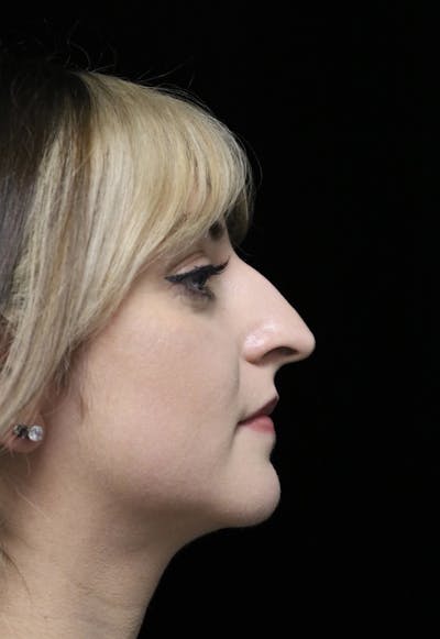 Beverly Hills Rhinoplasty Before & After Gallery - Patient 201183 - Image 1 Dr. Deepak Raj Dugar