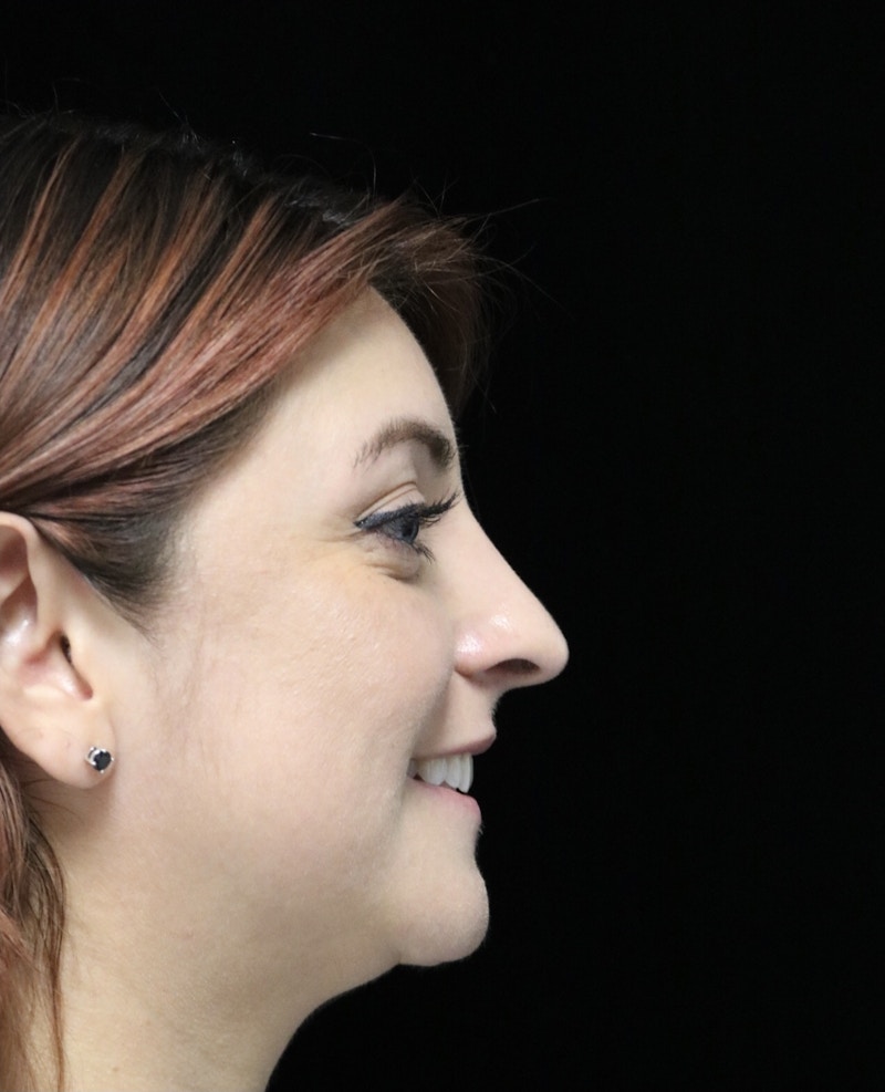 Beverly Hills Rhinoplasty Before & After Gallery - Patient 201183 - Image 8 Dr. Deepak Raj Dugar