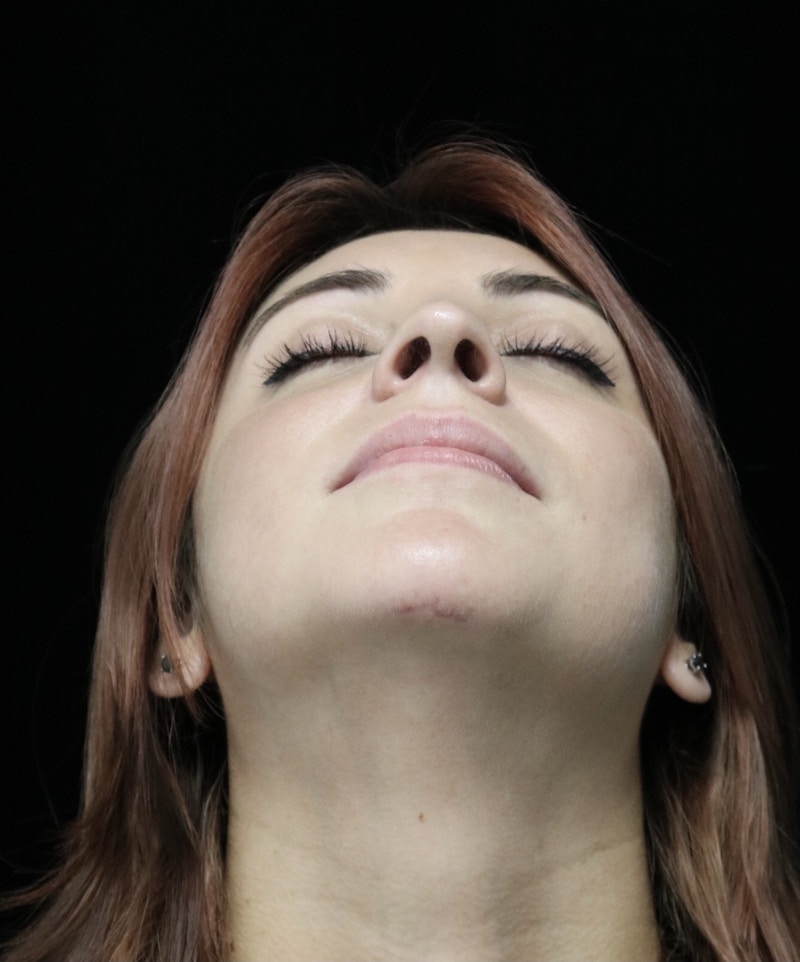 Beverly Hills Rhinoplasty Before & After Gallery - Patient 201183 - Image 14 Dr. Deepak Raj Dugar