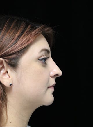 Beverly Hills Rhinoplasty Before & After Gallery - Patient 201183 - Image 2 Dr. Deepak Raj Dugar
