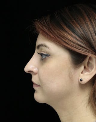 Beverly Hills Rhinoplasty Before & After Gallery - Patient 201183 - Image 10 Dr. Deepak Raj Dugar