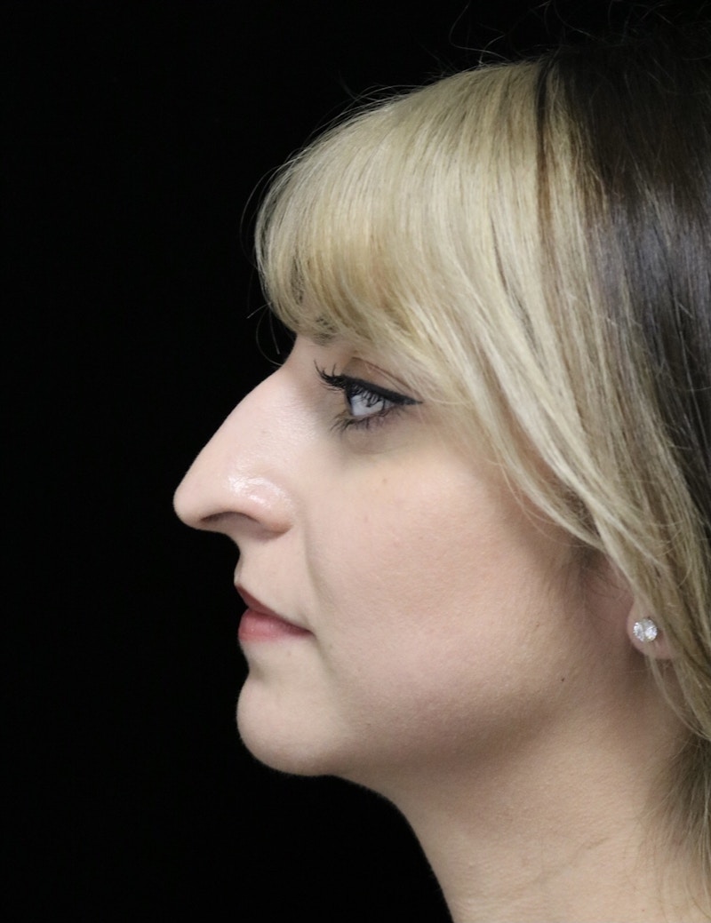Beverly Hills Rhinoplasty Before & After Gallery - Patient 201183 - Image 9 Dr. Deepak Raj Dugar