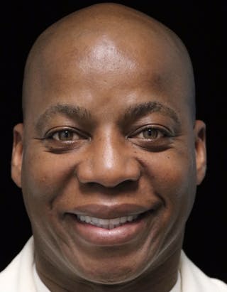 Beverly Hills Rhinoplasty Before & After Gallery - Patient 373022 - Image 4 Dr. Deepak Raj Dugar