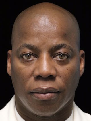 Beverly Hills Rhinoplasty Before & After Gallery - Patient 373022 - Image 6 Dr. Deepak Raj Dugar