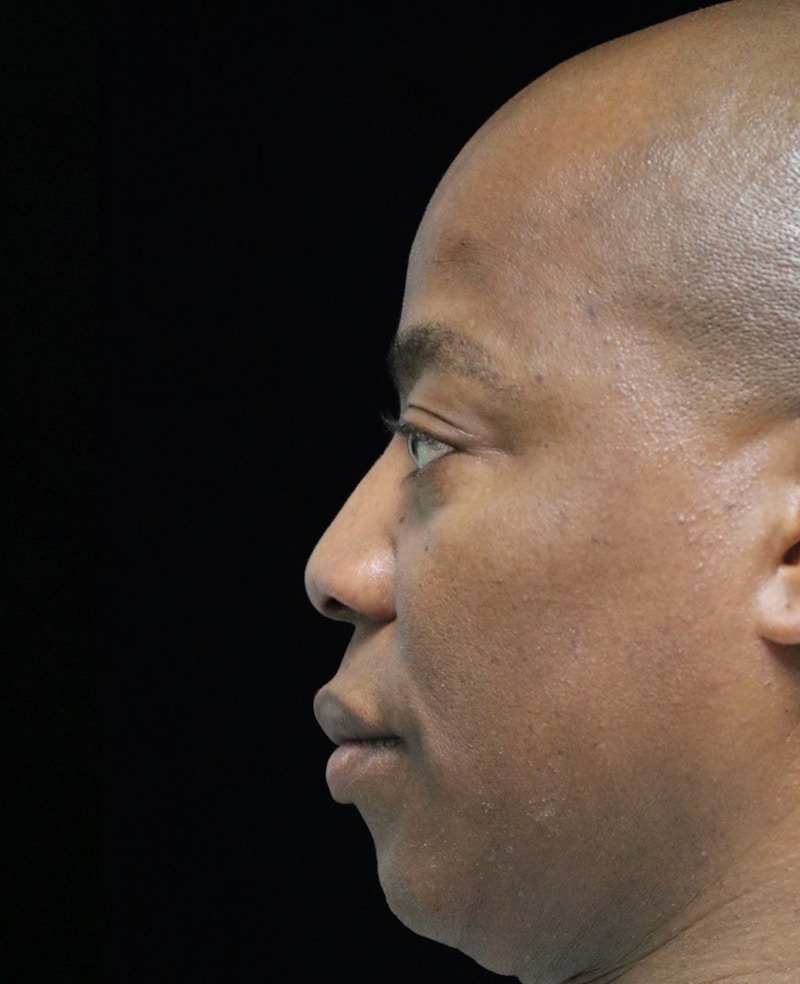 Beverly Hills Rhinoplasty Before & After Gallery - Patient 373022 - Image 10 Dr. Deepak Raj Dugar