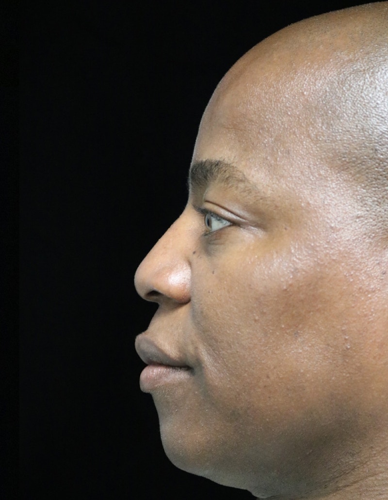 Beverly Hills Rhinoplasty Before & After Gallery - Patient 373022 - Image 9 Dr. Deepak Raj Dugar
