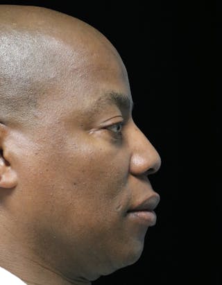 Beverly Hills Rhinoplasty Before & After Gallery - Patient 373022 - Image 2 Dr. Deepak Raj Dugar