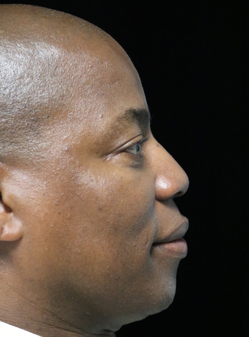 Beverly Hills Rhinoplasty Before & After Gallery - Patient 373022 - Image 1 Dr. Deepak Raj Dugar
