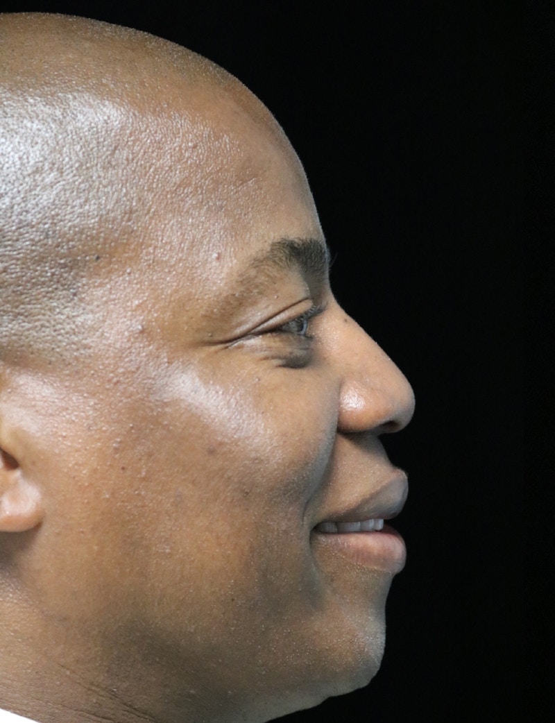 Beverly Hills Rhinoplasty Before & After Gallery - Patient 373022 - Image 11 Dr. Deepak Raj Dugar