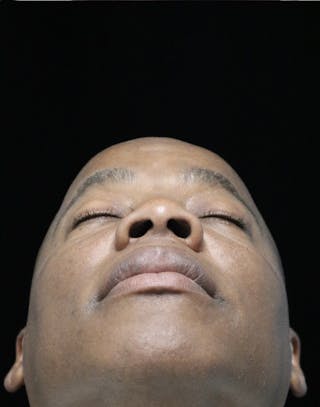 Beverly Hills Rhinoplasty Before & After Gallery - Patient 373022 - Image 16 Dr. Deepak Raj Dugar