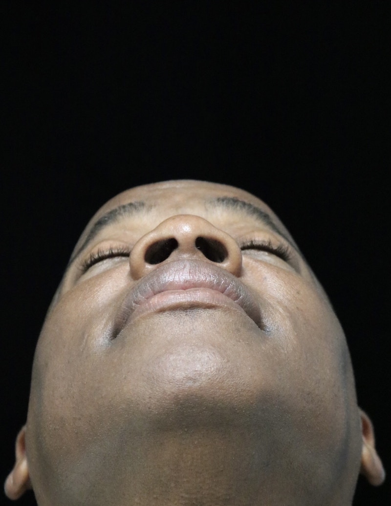 Beverly Hills Rhinoplasty Before & After Gallery - Patient 373022 - Image 15 Dr. Deepak Raj Dugar