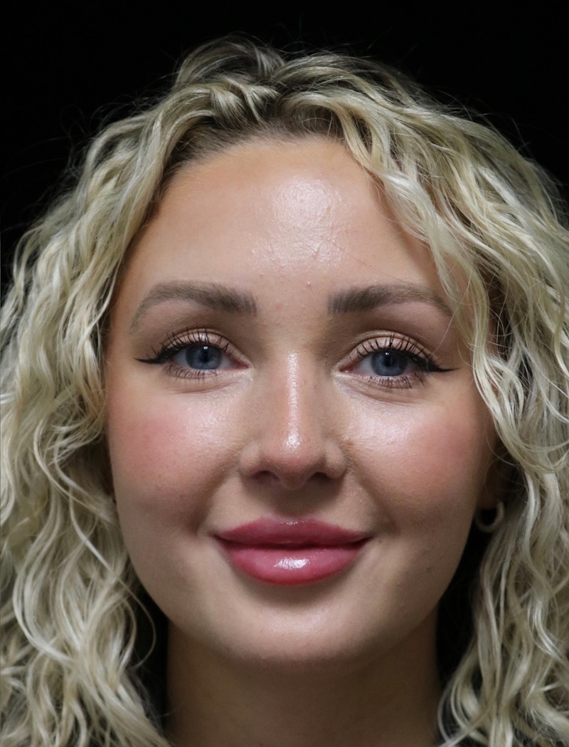 Beverly Hills Rhinoplasty Before & After Gallery - Patient 243077 - Image 8 Dr. Deepak Raj Dugar