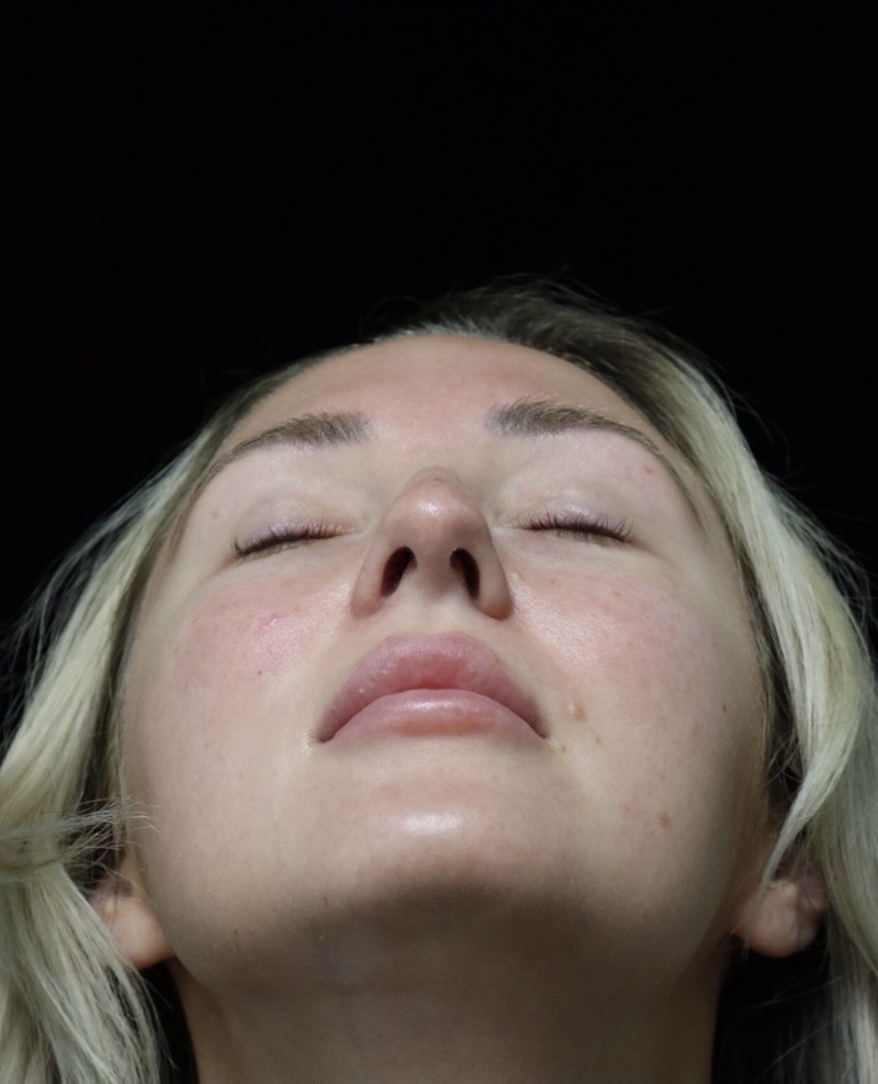 Beverly Hills Rhinoplasty Before & After Gallery - Patient 243077 - Image 13 Dr. Deepak Raj Dugar