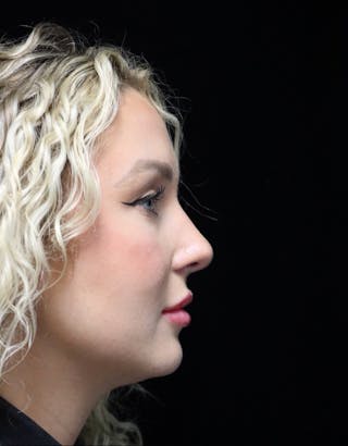 Beverly Hills Rhinoplasty Before & After Gallery - Patient 243077 - Image 2 Dr. Deepak Raj Dugar