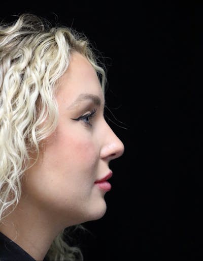 Beverly Hills Rhinoplasty Before & After Gallery - Patient 243077 - Image 2 Dr. Deepak Raj Dugar