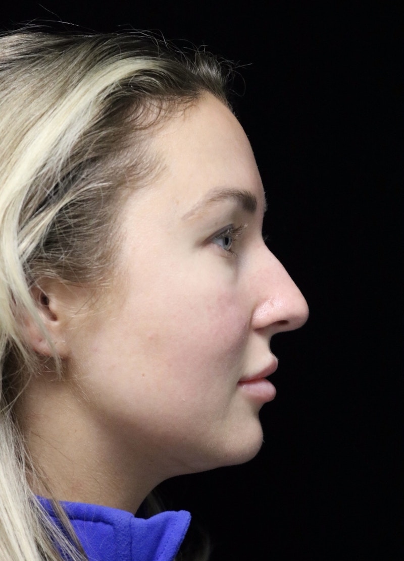 Beverly Hills Rhinoplasty Before & After Gallery - Patient 243077 - Image 1 Dr. Deepak Raj Dugar