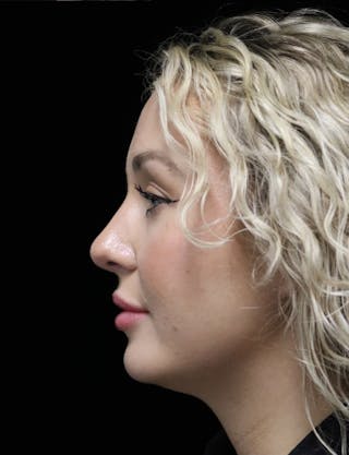 Beverly Hills Rhinoplasty Before & After Gallery - Patient 243077 - Image 12 Dr. Deepak Raj Dugar