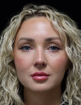 Beverly Hills Rhinoplasty Before & After Gallery - Patient 243077 - Image 6 Dr. Deepak Raj Dugar