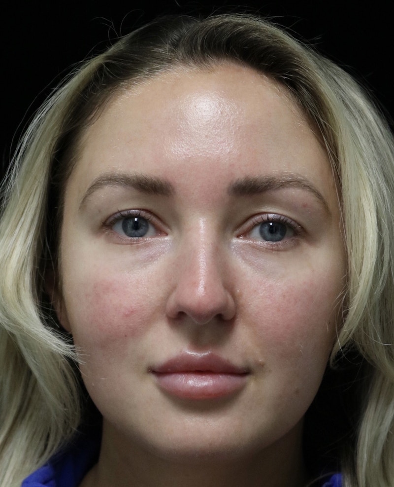 Beverly Hills Rhinoplasty Before & After Gallery - Patient 243077 - Image 5 Dr. Deepak Raj Dugar