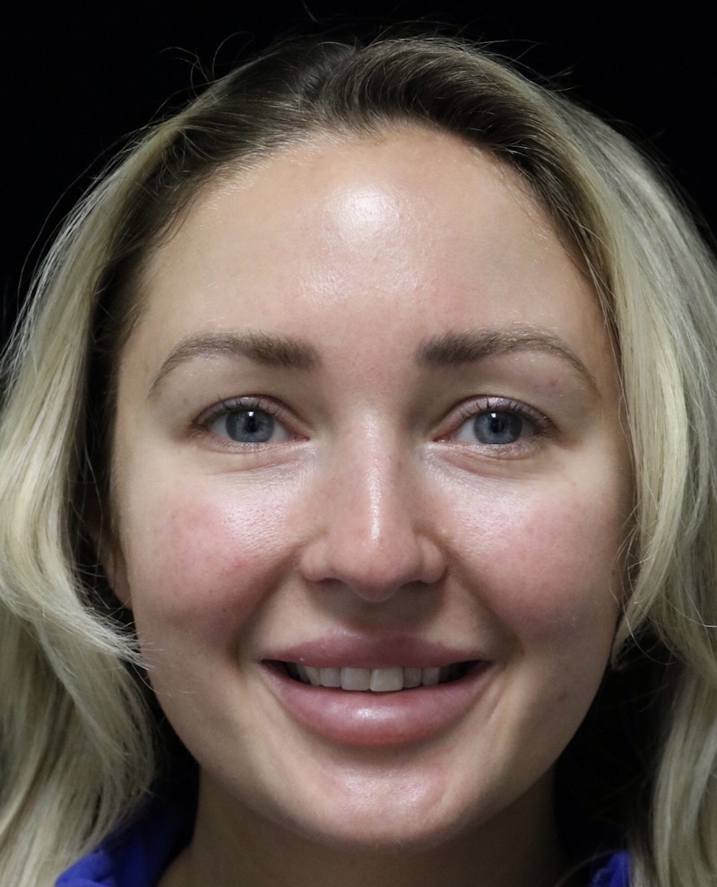 Beverly Hills Rhinoplasty Before & After Gallery - Patient 243077 - Image 7 Dr. Deepak Raj Dugar