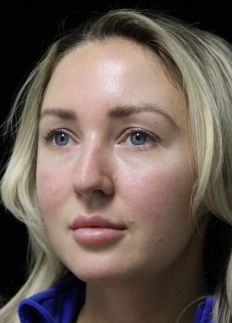 Beverly Hills Rhinoplasty Before & After Gallery - Patient 243077 - Image 9 Dr. Deepak Raj Dugar