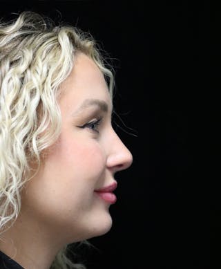 Beverly Hills Rhinoplasty Before & After Gallery - Patient 243077 - Image 4 Dr. Deepak Raj Dugar