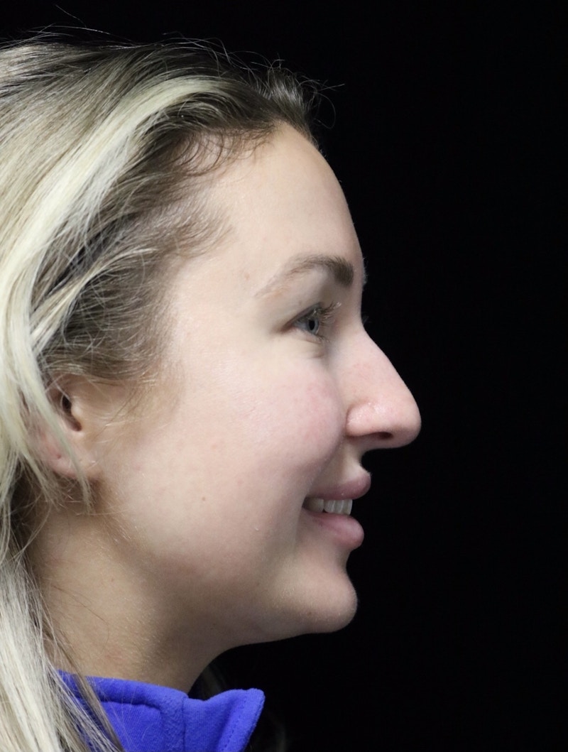 Beverly Hills Rhinoplasty Before & After Gallery - Patient 243077 - Image 3 Dr. Deepak Raj Dugar