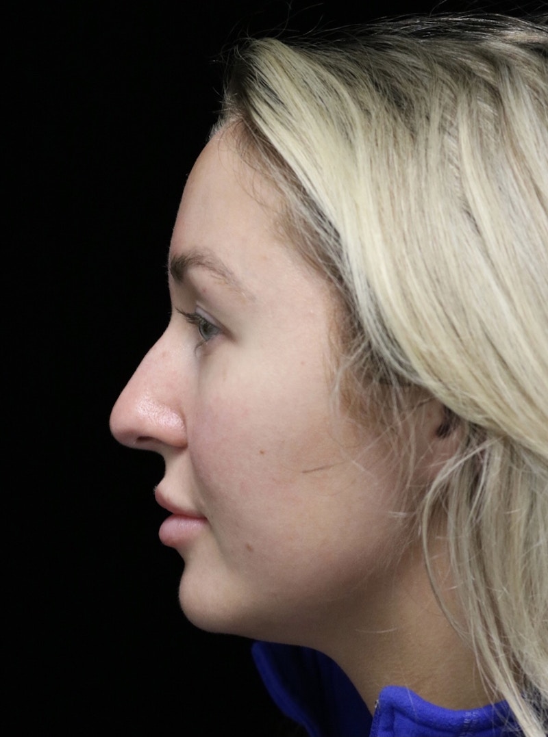 Beverly Hills Rhinoplasty Before & After Gallery - Patient 243077 - Image 11 Dr. Deepak Raj Dugar