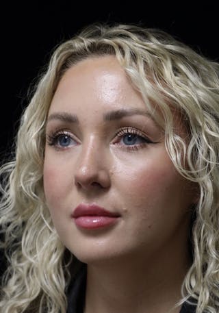 Beverly Hills Rhinoplasty Before & After Gallery - Patient 243077 - Image 10 Dr. Deepak Raj Dugar