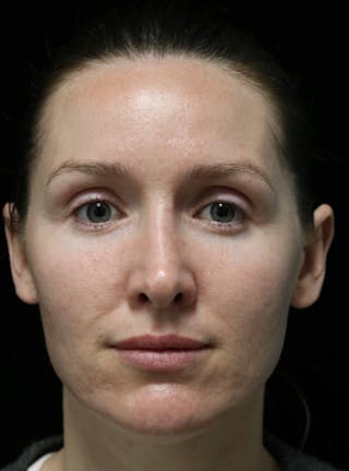 Beverly Hills Rhinoplasty Before & After Gallery - Patient 132750 - Image 6 Dr. Deepak Raj Dugar