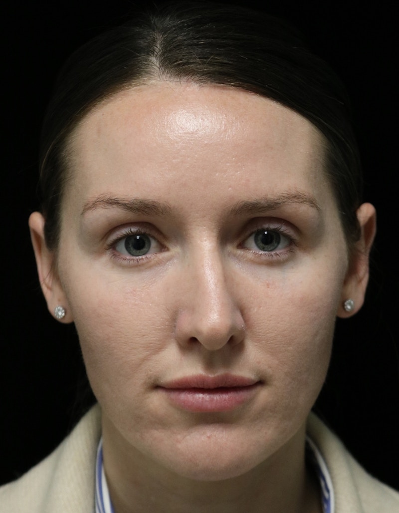 Beverly Hills Rhinoplasty Before & After Gallery - Patient 132750 - Image 5 Dr. Deepak Raj Dugar