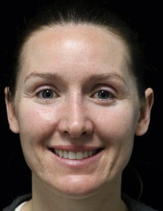 Beverly Hills Rhinoplasty Before & After Gallery - Patient 132750 - Image 8 Dr. Deepak Raj Dugar