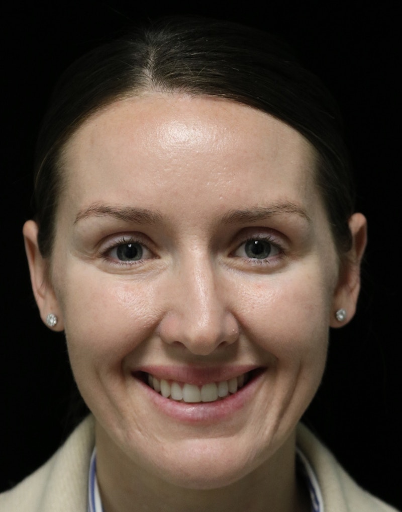 Beverly Hills Rhinoplasty Before & After Gallery - Patient 132750 - Image 7 Dr. Deepak Raj Dugar