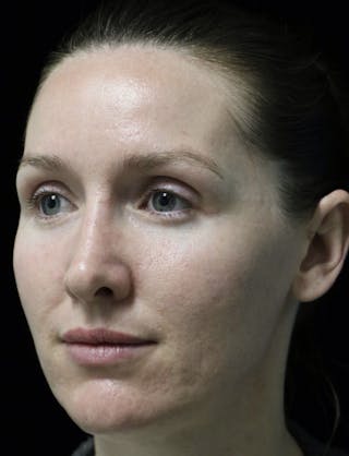 Beverly Hills Rhinoplasty Before & After Gallery - Patient 132750 - Image 10 Dr. Deepak Raj Dugar