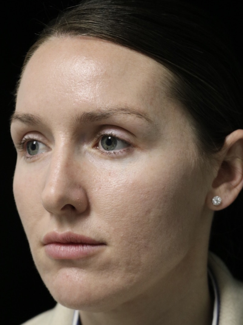Beverly Hills Rhinoplasty Before & After Gallery - Patient 132750 - Image 9 Dr. Deepak Raj Dugar