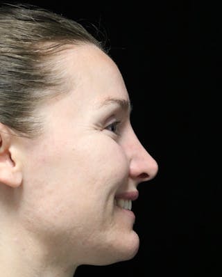 Beverly Hills Rhinoplasty Before & After Gallery - Patient 132750 - Image 4 Dr. Deepak Raj Dugar