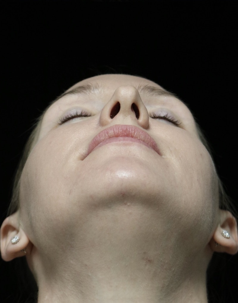 Beverly Hills Rhinoplasty Before & After Gallery - Patient 132750 - Image 13 Dr. Deepak Raj Dugar