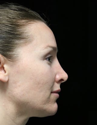 Beverly Hills Rhinoplasty Before & After Gallery - Patient 132750 - Image 2 Dr. Deepak Raj Dugar