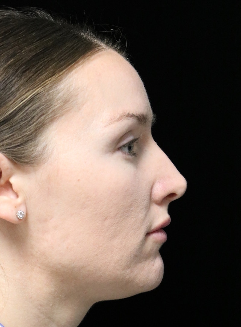 Beverly Hills Rhinoplasty Before & After Gallery - Patient 132750 - Image 1 Dr. Deepak Raj Dugar