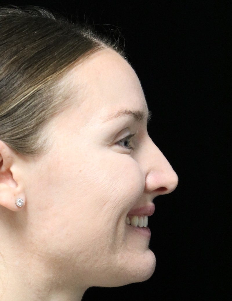 Beverly Hills Rhinoplasty Before & After Gallery - Patient 132750 - Image 3 Dr. Deepak Raj Dugar