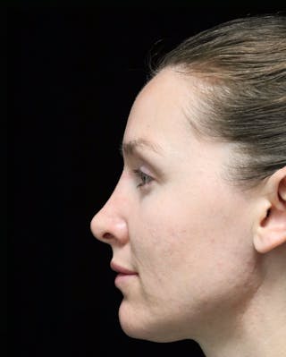 Beverly Hills Rhinoplasty Before & After Gallery - Patient 132750 - Image 12 Dr. Deepak Raj Dugar