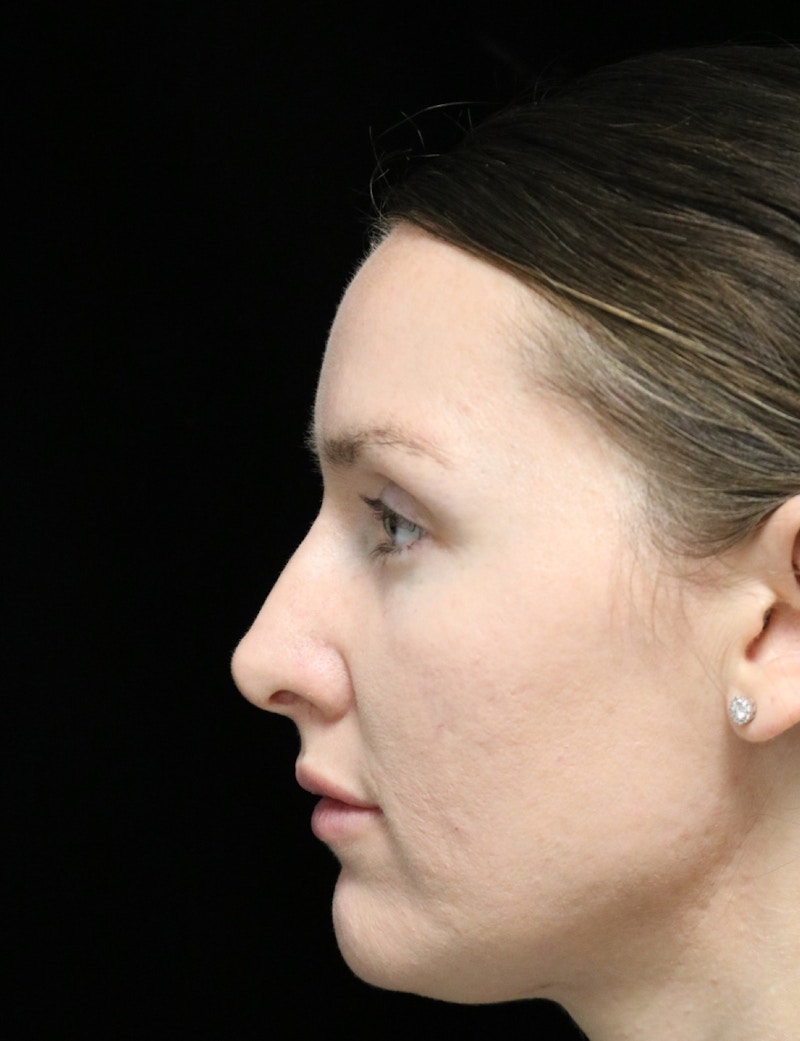Beverly Hills Rhinoplasty Before & After Gallery - Patient 132750 - Image 11 Dr. Deepak Raj Dugar